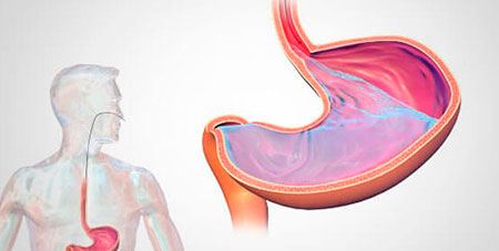 MANOMETRIA ESOFÁGICA